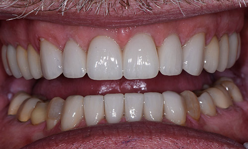 rivercrest_family_dental-gallery-upper-arch-after-2-v2