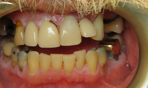 Before-gallery-overdentures-before-1