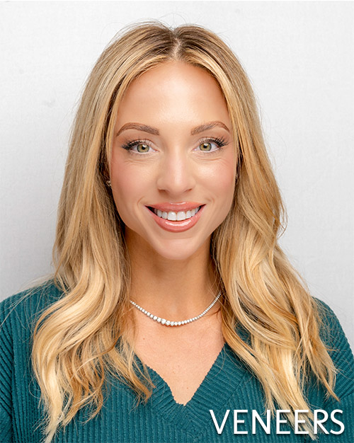 Veneers