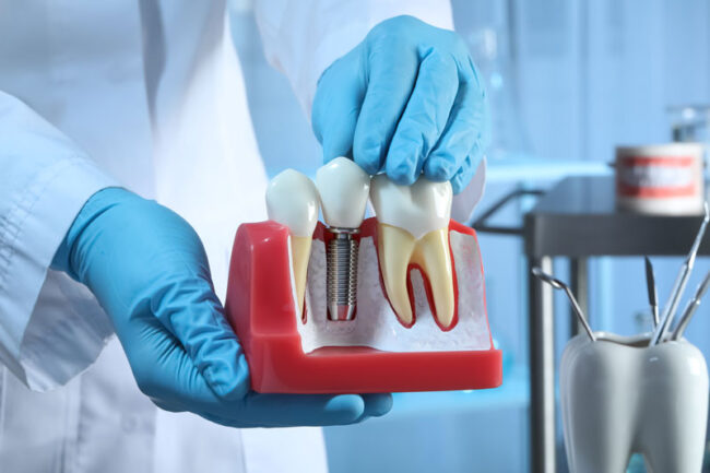 2024-05 – doctor holding impant model Discover the benefits of dental implants: restore your smile and confidence with our expert implant services. Schedule a consultation today!