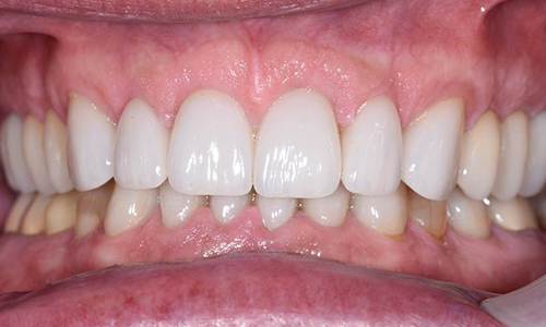 Crowns-After