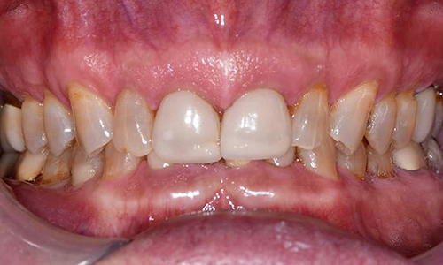 Crowns-Before