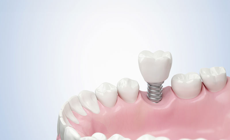 IMP2-Closeup-white-tooth-and-gum-with-Dental-implant-Human-Teeth-for-Medical-Concept
