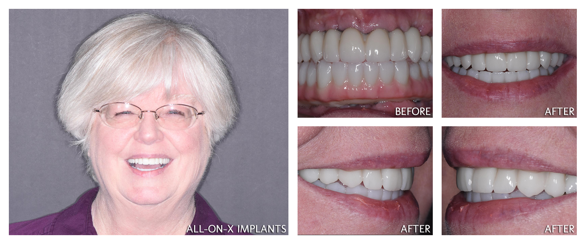 Full-mouth implant restorations