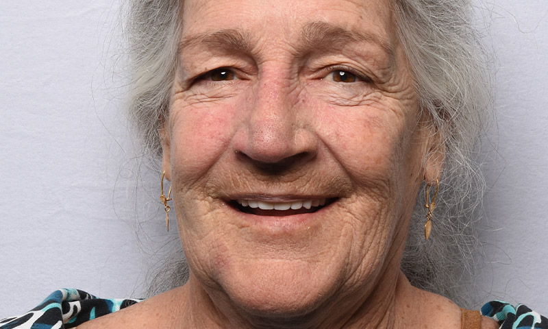 After Woman smiling with teeth after her treatment