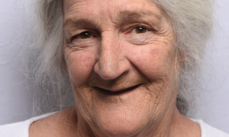 Before An image of a woman with no teeth before treatment