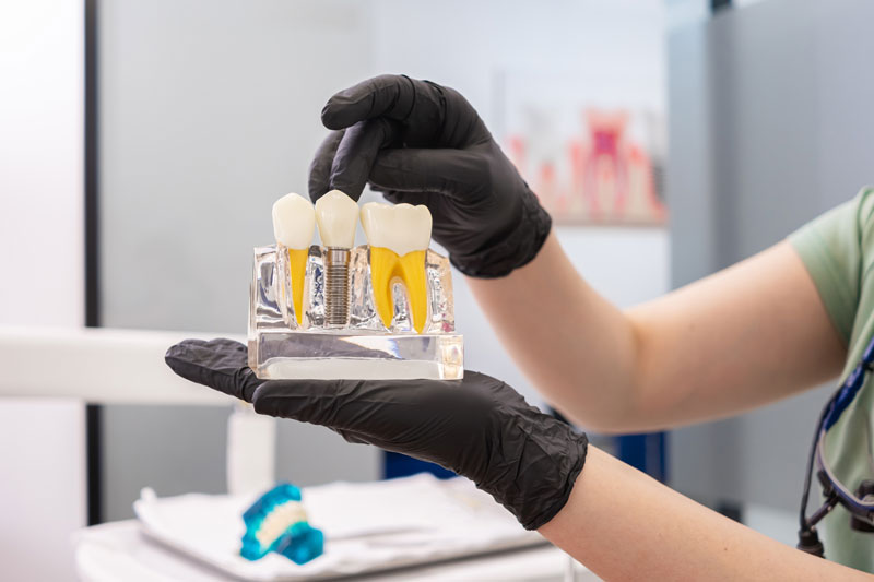 Dental-expert-holding-human-teeth-model,-pointing-to-the-crown-of-a-dental-implant,-and-offering-advice-on-dental-implant-maintenance-and-healthy-teeth-care Dental expert holding human teeth model, pointing to the crown of a dental implant, and offering advice on dental implant maintenance and healthy teeth care.